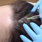Alopecia sau caderea parului - Clinica Medicum