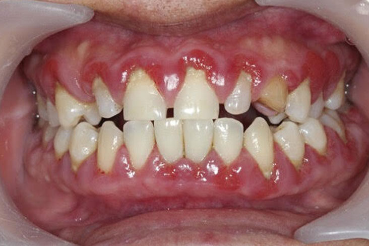 boala parodontala, doctor oana stoica - clinica medicum