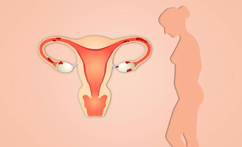 endometrioza - clinica medicum