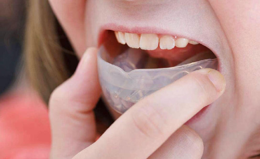 dispozitivele de avansare mandibulara - clinica medicum stomatologie